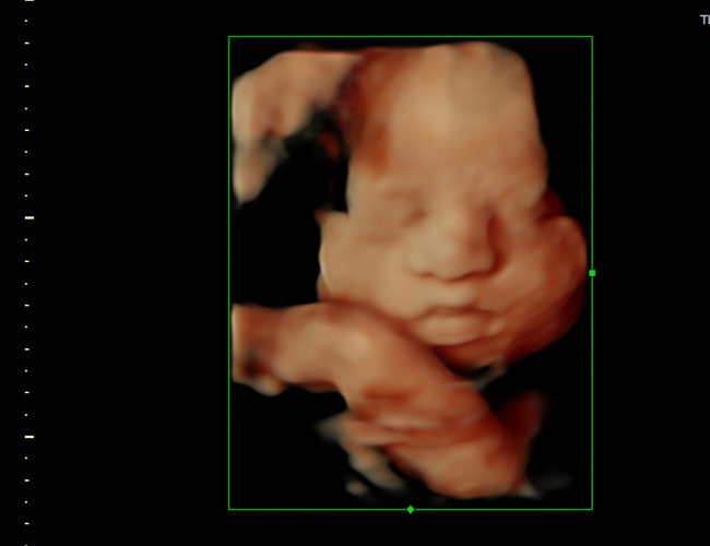 3D ultrasound image at 29 weeks